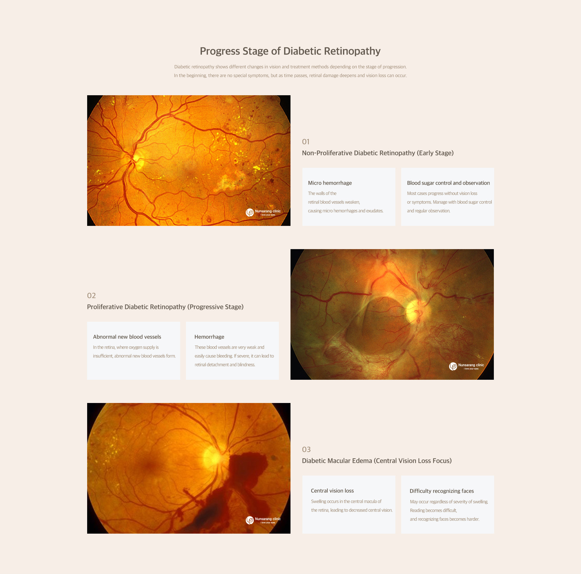 Diabetic Retinopathy